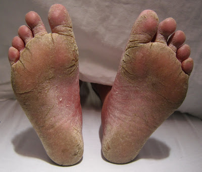 Athlete's foot | Athlete's Foot Treatment | How to get rid of Athlete's foot