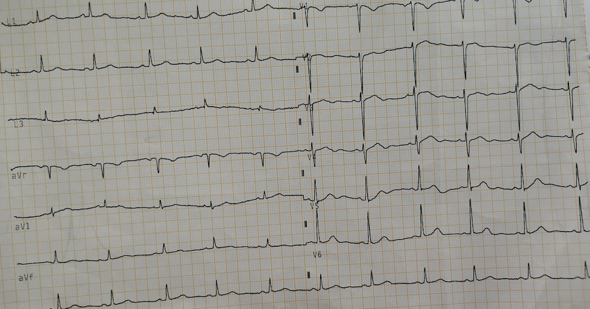 Heart failure with preserved ejection fraction