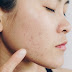 Tahapan Skin Care yang Perlu Anda Lakukan untuk Menghilangkan Bekas Jerawat