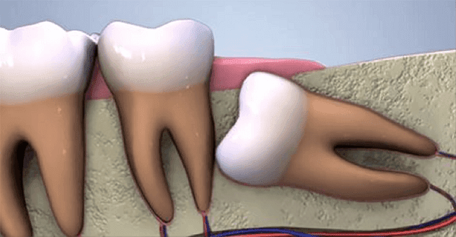 The Wisdom Teeth Dental Scam: The Hidden Truth
