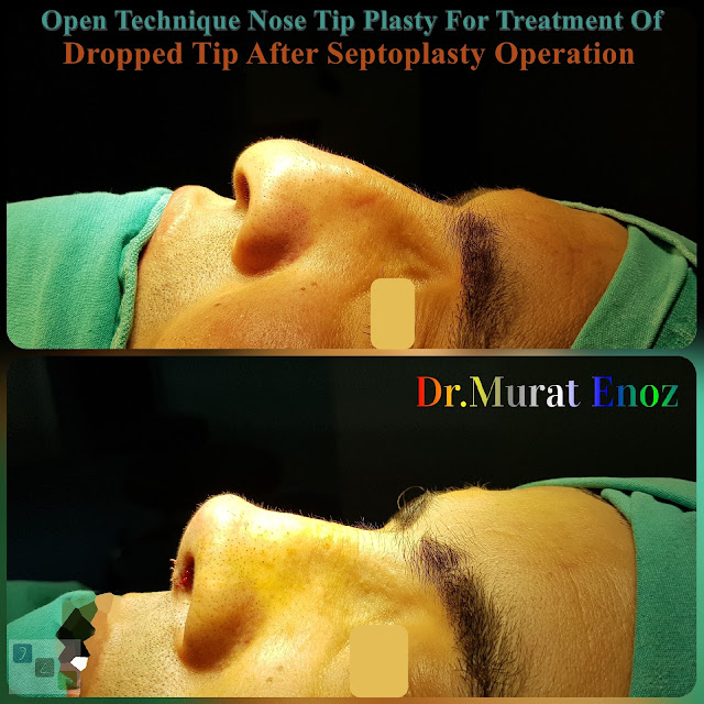Open Technique Nose Tip Plasty For Treatment Of  Dropped Tip After Septoplasty Operation