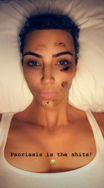 Kim Kardashain is diagnosed with psoriasis Celebrities' illnesses