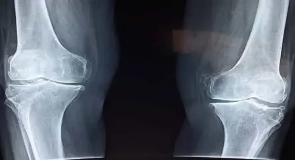 4 degrees of knee roughness and how to treat it 4 degrees of knee roughness and how to treat it