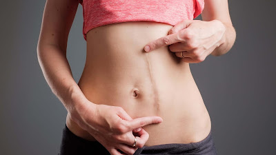 Diferencias entre el parto natural y la cesárea