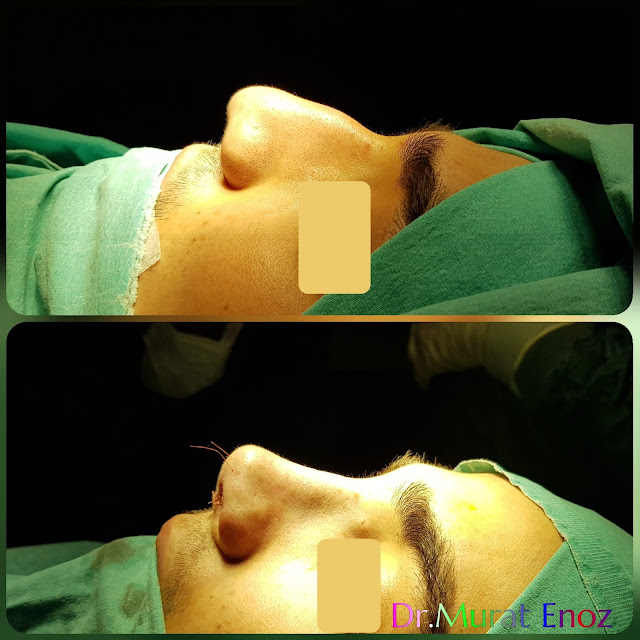 Male rhinoplasty- Nose job for men Istanbul Turkey