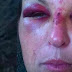 Une gardienne sauvagement battu à coups de pelle par un père ivre à qui elle ne voulait pas remettre ses enfants.