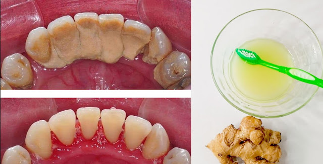 Eliminer la plaque dentaire en quelques minutes avec ces astuces naturelles