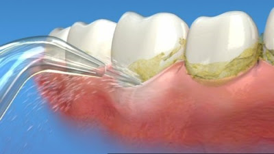 Các bước cạo vôi răng bằng máy siêu âm an toàn 2