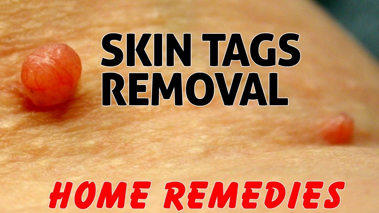 Home Remedies To Remove Skin Tags Naturally At Home Without Going To A Doctor Healthy Lifestyle
