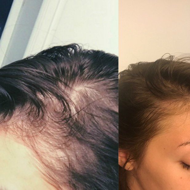 Telogen Effluvium & Hormonal Hair Loss/Thinning Update What Has Worked Beauty without Limits