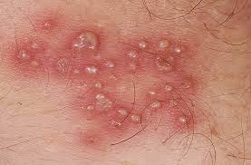 bintik herpes bintik herpes