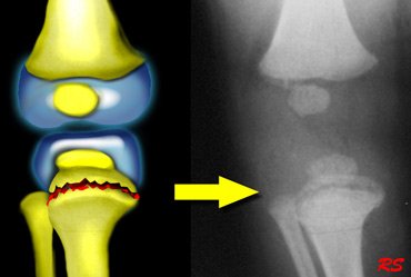 Fracture/Dislocation/Sublaxation ~ Anatomy for MSP