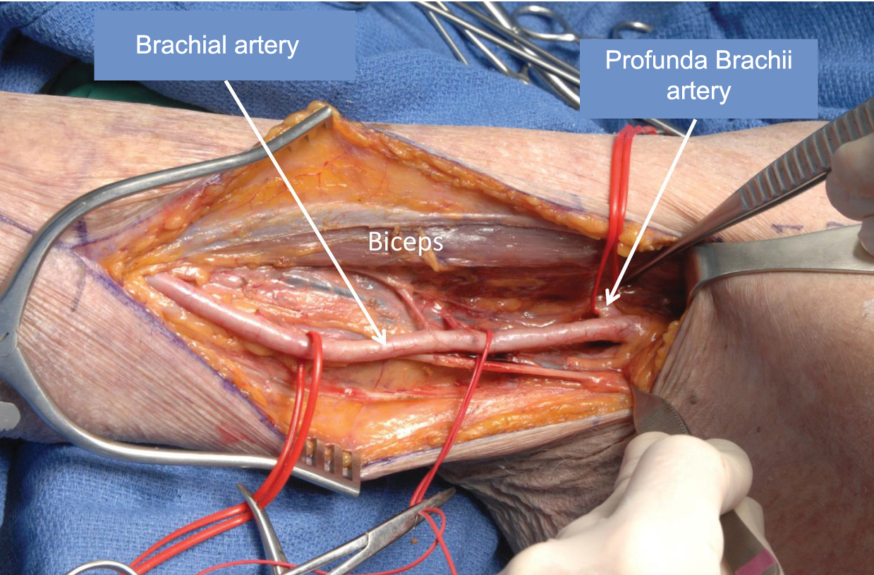 Medical Terms & Сlinical Сases : Brachial artery