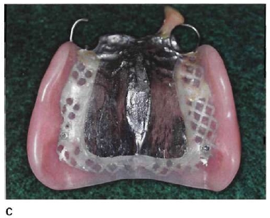 hiphoplife: Maxillary major connectors : Types