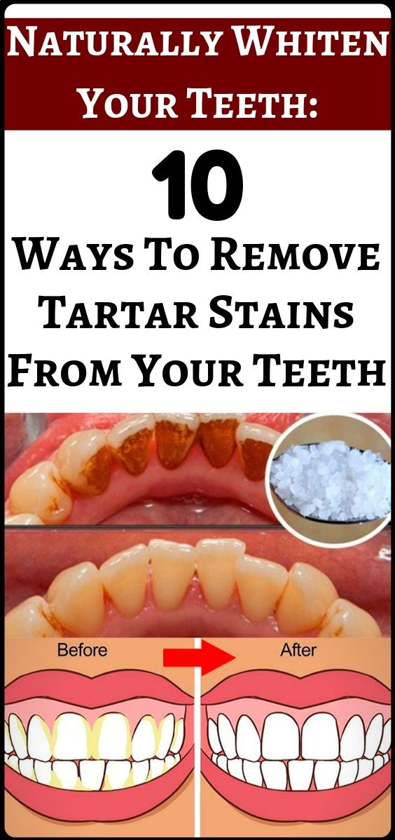Naturally Whiten Teeth 10 Ways To Remove Tartar Stains From Your Teeth