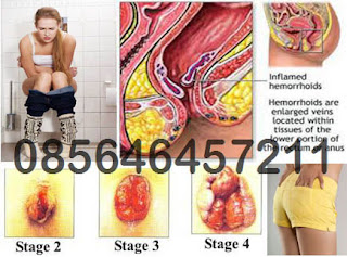 Bahaya Penyakit Hemorrhoid (Wasir)