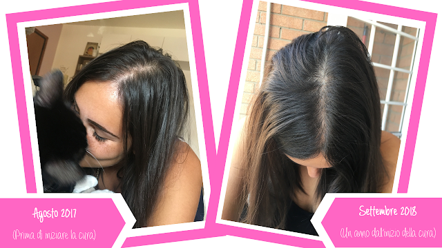 Alopecia Androgenetica Femminile - La mia esperienza, un anno dopo!