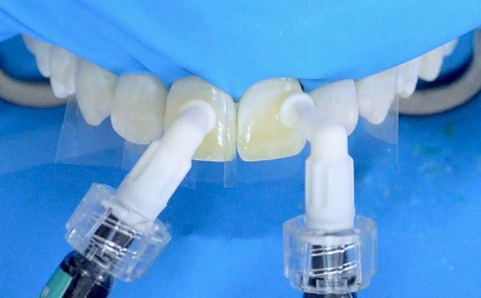 STEP BY STEP: Fluorosis treatment using ICON infiltration