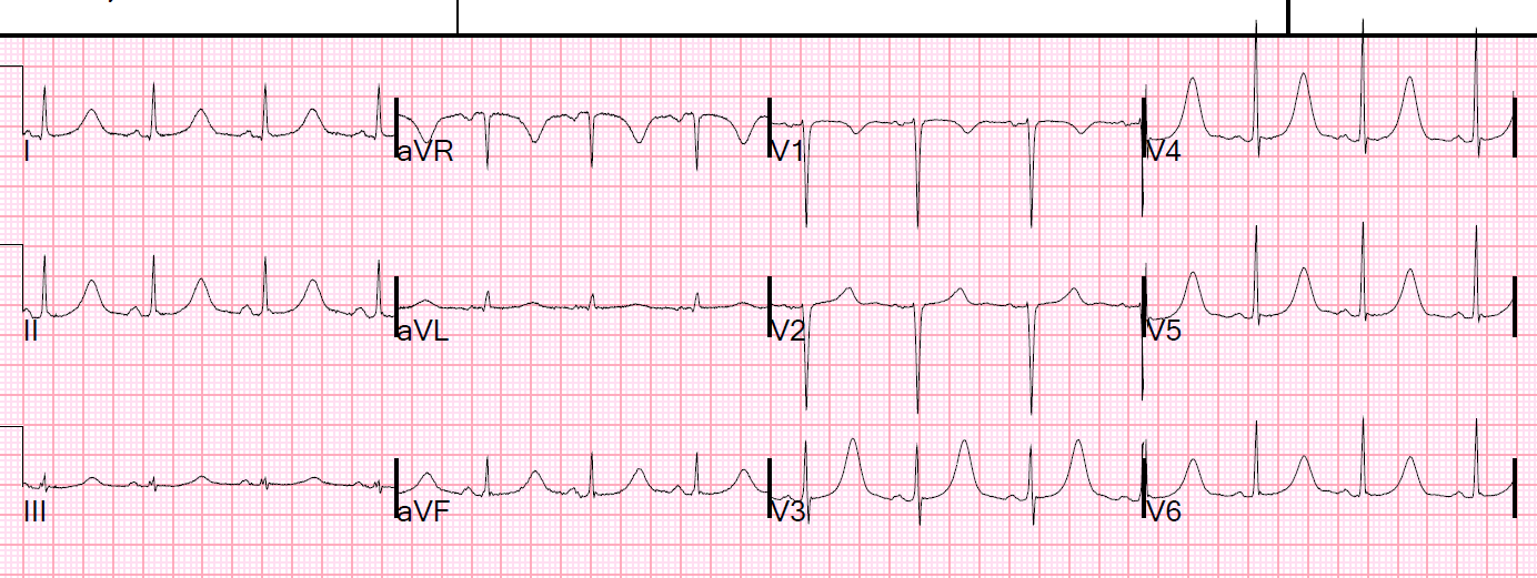 Dr. Smith's ECG Blog Potassium and Magnesium how low is too low?