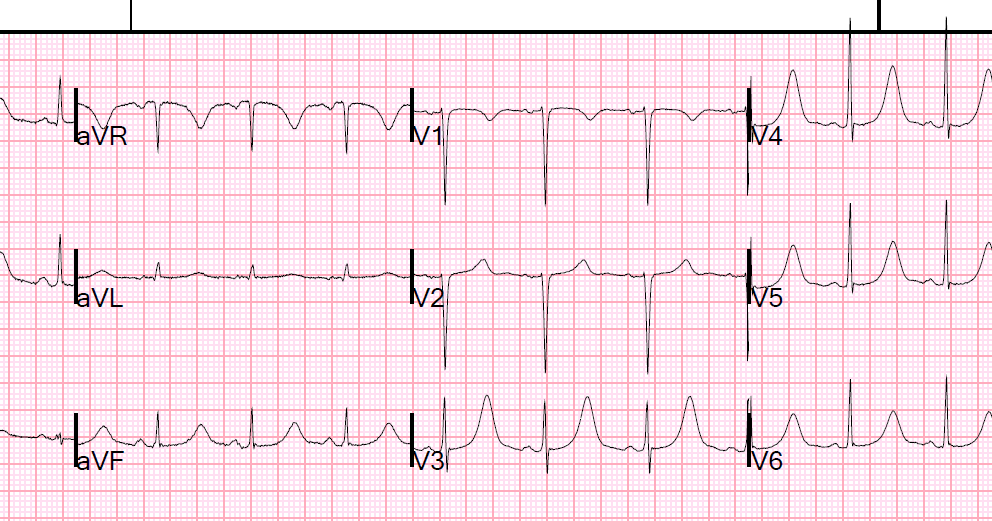 Dr. Smith's ECG Blog Potassium and Magnesium how low is too low?