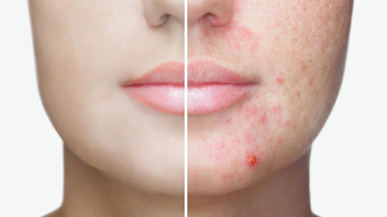 What Causes Acne? Is It The Hormones, Or Something Else?