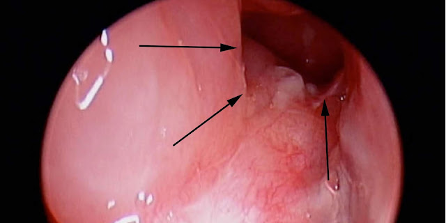 hình ảnh về điều trị polyp cổ tử cung