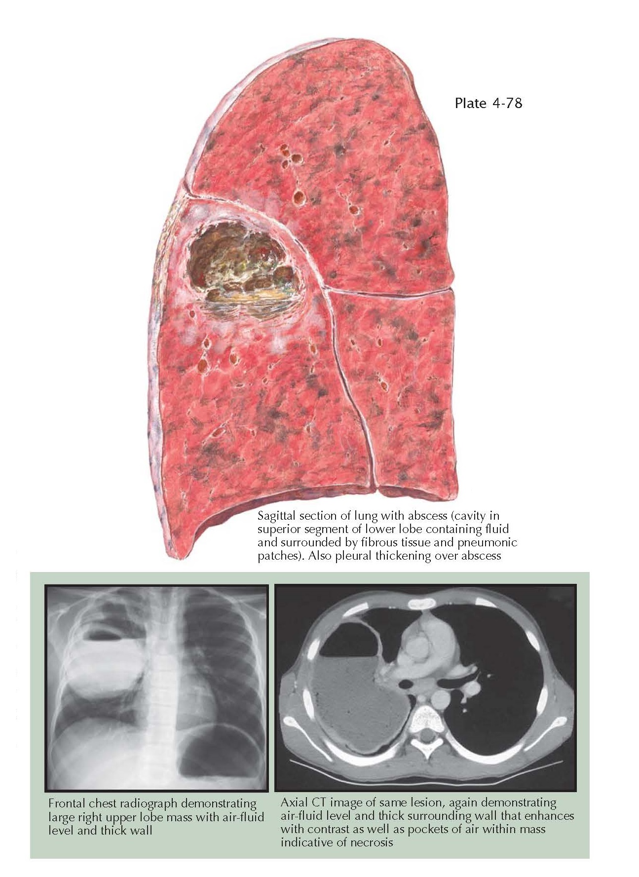 LUNG ABSCESS - pediagenosis