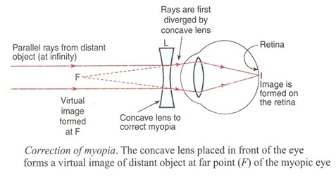 Human Eye defe5 - मानव नेत्र और उसके दोष