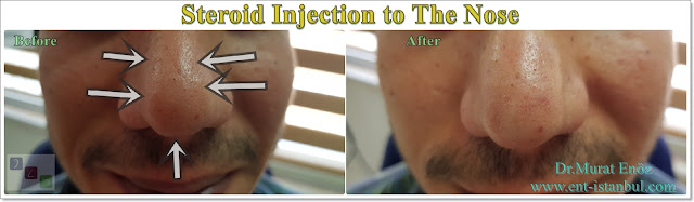 Steroid injection after rhinoplasty