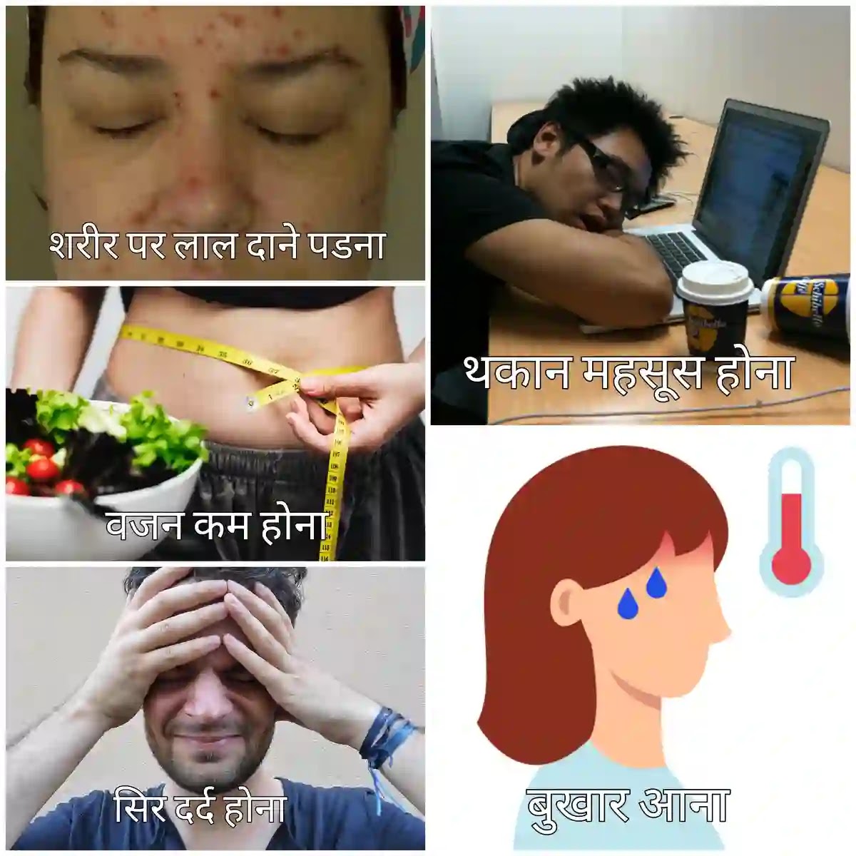 चिकन पॉक्स (छोटी माता): लक्षण, कारण, इलाज इत्यादि चिकन पॉक्स के लक्षण क्या हैं