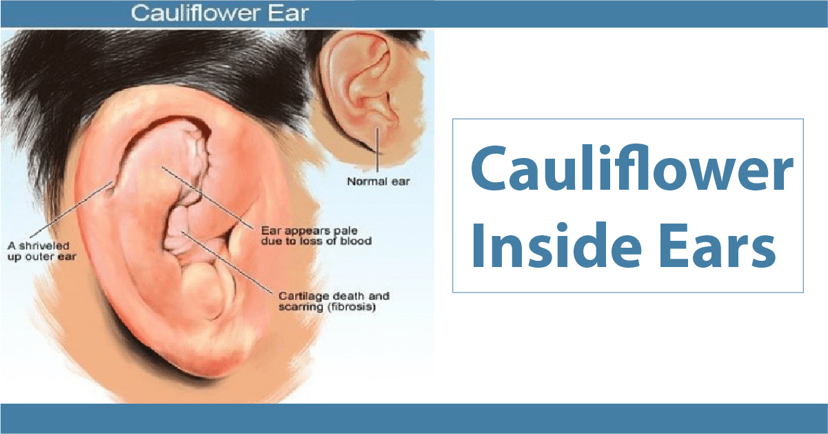 Cauliflower Ear Vikram ENT Hospital & Research Institute