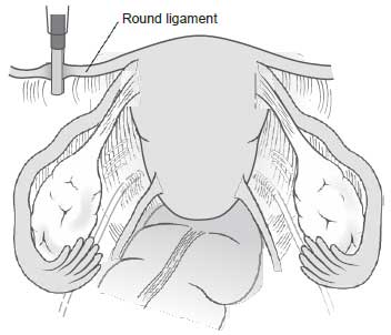 left round ligament