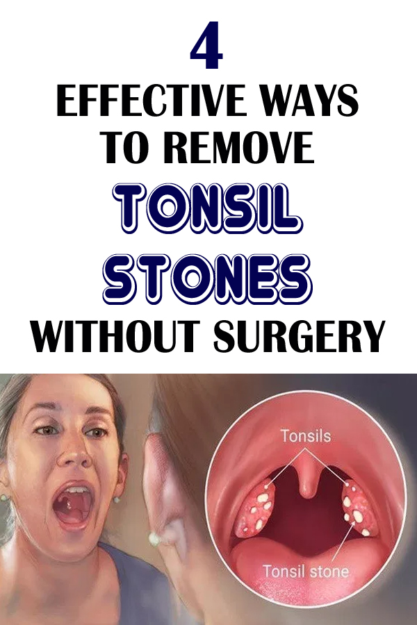 4 Effective Ways To Remove Tonsil Stones Without Surgery