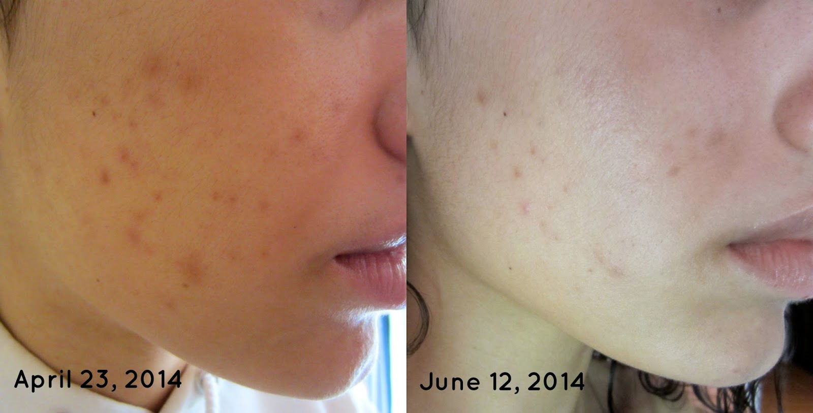 Pond's Clarant B3 Dark Spot Correcting Cream Before And After