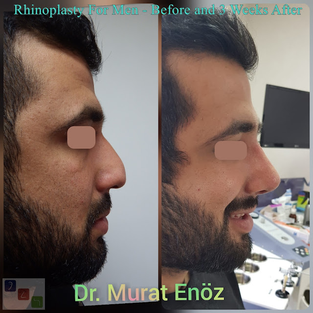 Rhinoplasty For Men - Before and 3 Weeks After - Male Nose Job Turkey