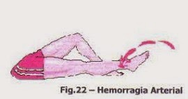 -: 130 – HEMORRAGIAS(Hemorragias)