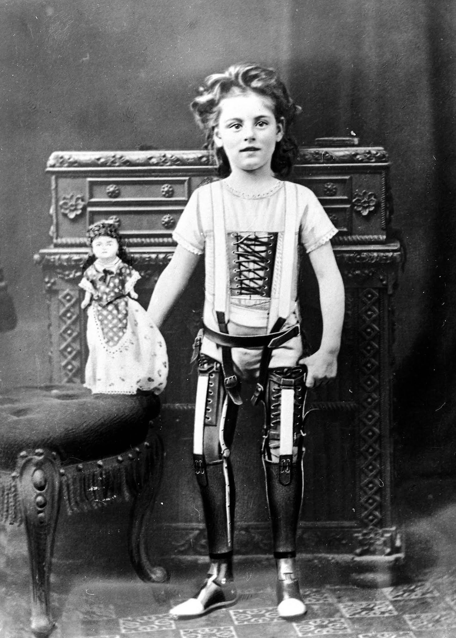The extraordinary early prostheses made by James Gillingham  1900 - 10