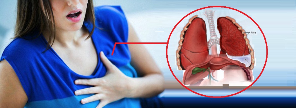 MENCARI TAHU PENYAKIT PARU PARU TERENDAM CAIRAN / PNEUMONIA