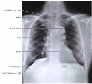 Chest : PA View | Radiology Basics | Radtechonduty