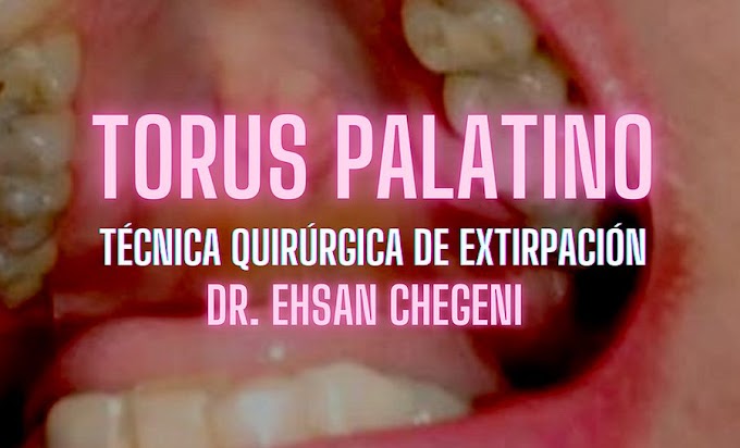 TORUS PALATINO: Técnica quirúrgica de extirpación -  Dr. Ehsan Chegeni