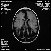 Jacob's Brain Injury