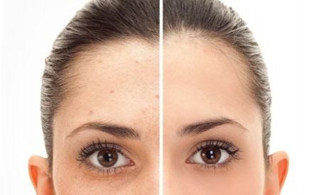 How to reduce hyperpigmentation and remove dark spot