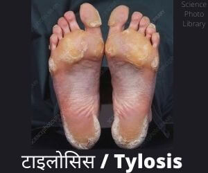 टाइलोसिस/Tylosis