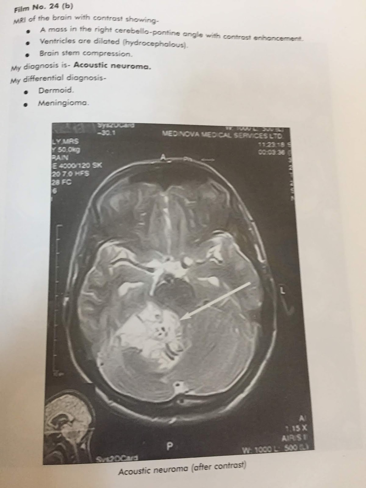 CT SCAN OF BRAIN-14