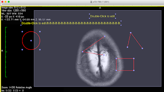 draw freehand roi in osirix lite draw freehand roi in osirix lite