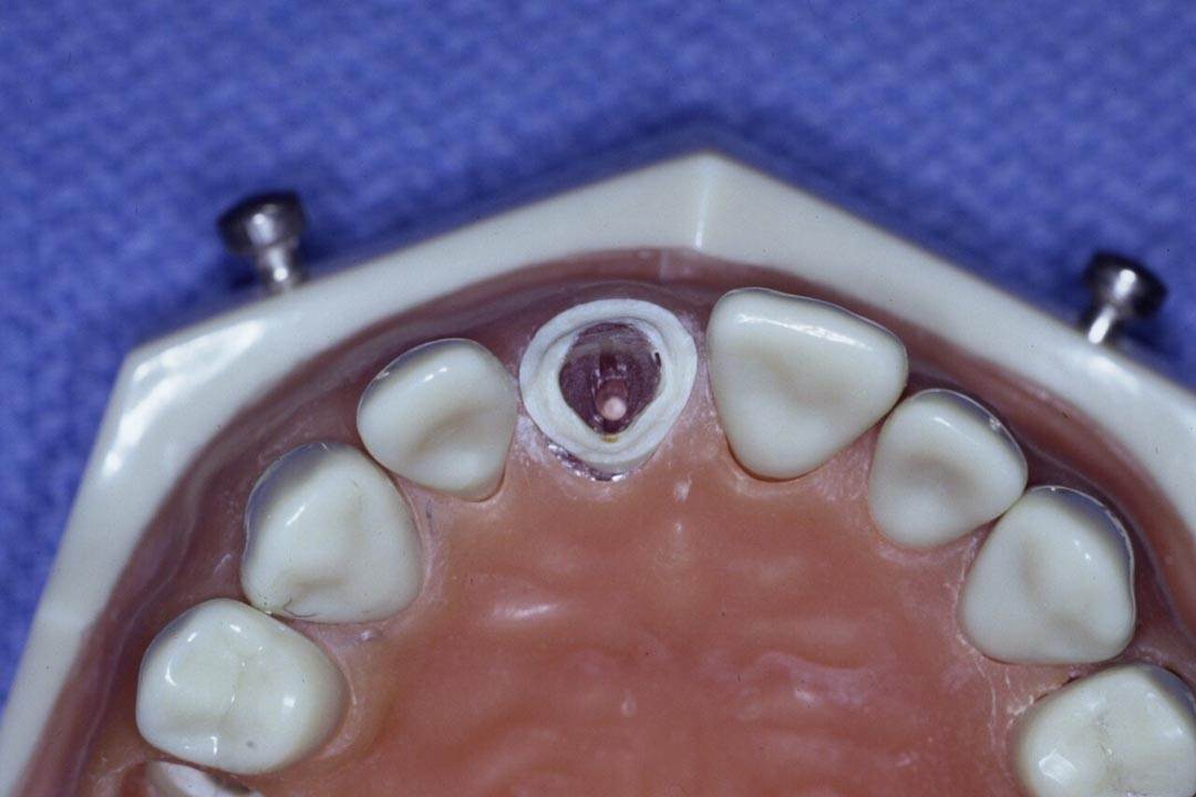 Dentistry Custom Cast Dowel Core