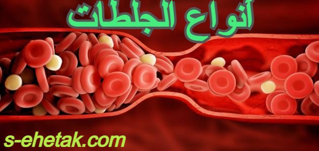 أنواع الجلطات أنواع الجلطات