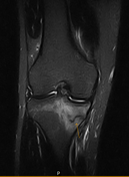 Medial Tibial Condyle Stress Fracture Mri Sumers Radiology Blog