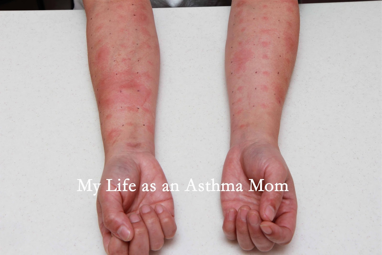 Allergy To Cats Shots For Cat Allergies