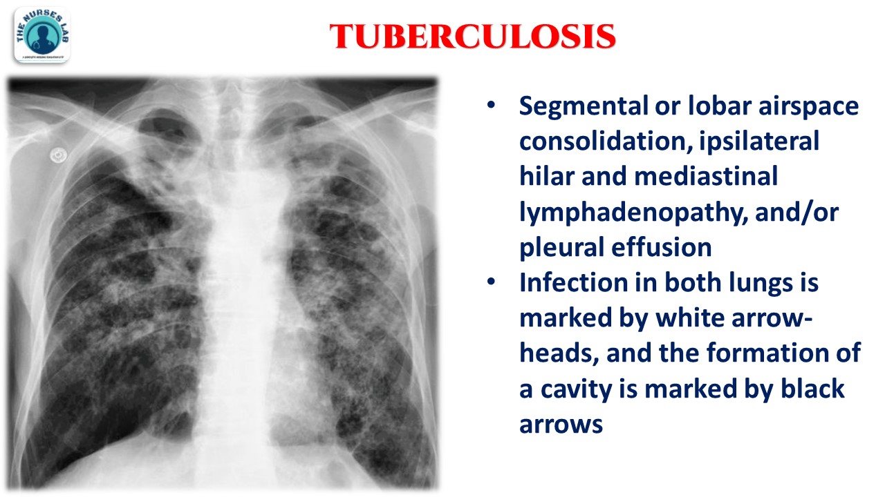 Tuberculosis Chest X Ray Findings tuberculosis-chest-x-ray-findings